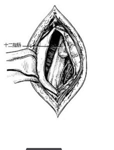 十二指腸腺癌