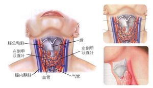 橋本甲狀腺炎 