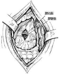 脾切除術