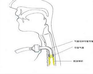 醫源性氣管及主支氣管損傷