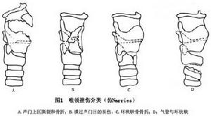 喉部鈍挫傷