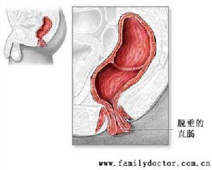 直腸脫垂