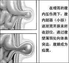 老年疝氣