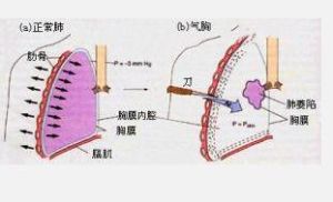 胸內壓