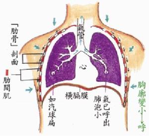 膈膨出