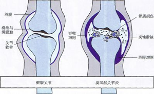 類風濕關節炎