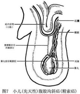 疝囊