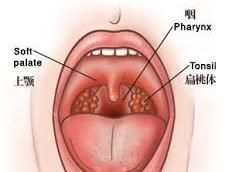 扁桃腺結石