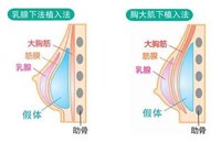 隆胸手術