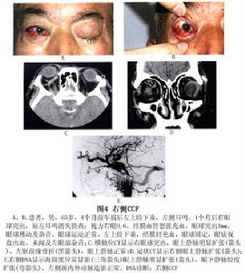 頸動脈海綿竇瘺