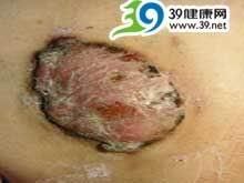外陰隆凸性皮膚纖維肉瘤