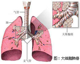 大咯血