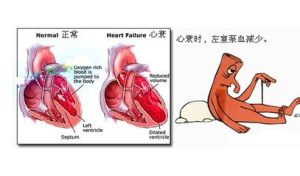 急性左側心力衰竭