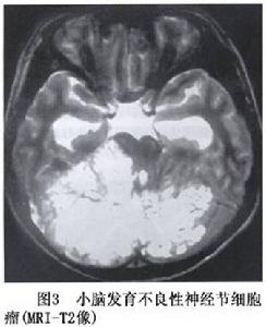 神經元腫瘤和神經元與神經膠質混合性腫瘤