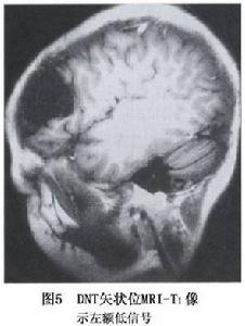 神經元腫瘤和神經元與神經膠質混合性腫瘤