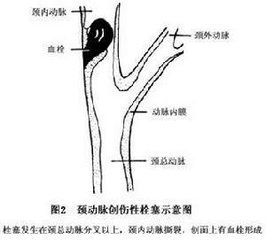 頸動脈創傷性栓塞