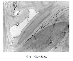 （圖）軟骨黏液樣纖維瘤