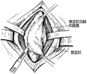 腹直肌鞘 