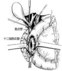 假性胰腺囊腫