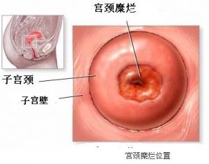 宮頸糜爛位置