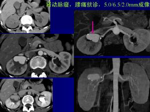 腎動脈瘤