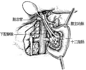 主動脈夾層分離