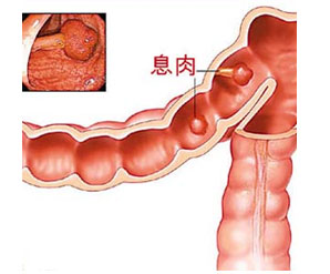 腸道息肉