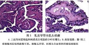 （圖）乳房導管內乳頭狀瘤