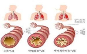 支氣管哮喘分類