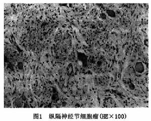 縱隔自主神經系腫瘤