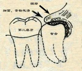 盡根牙