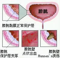 慢性膀胱炎