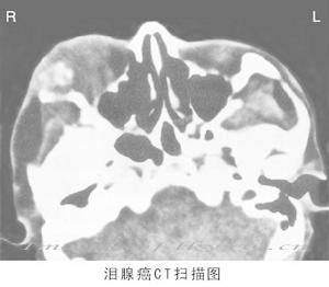 淚腺多形性腺瘤