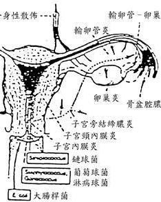 急性輸卵管炎