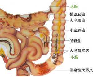 壞死性小腸結腸炎