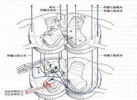 脊髓內膠質增生