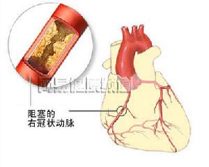 《急性心肌梗死的診斷和治療》