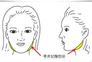 下頜角整形手術