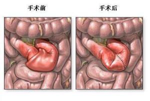 機械性腸梗阻術前術後對比