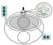 腹部衝擊法上面