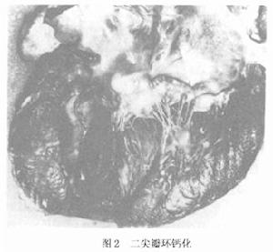 主動脈瓣膜部狹窄