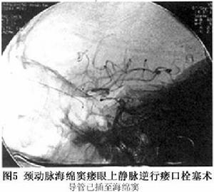 頸動脈海綿竇瘺