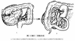 十二指腸旁疝 圖2