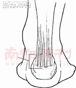 跟腱前囊炎