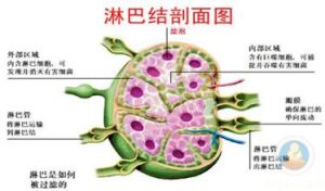 原發免疫性疾病相關的淋巴增殖性疾病