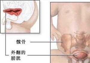 泄殖腔外翻