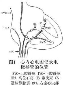 電生理檢查