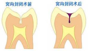 兒童窩溝封閉