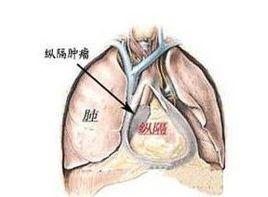 氣管和縱隔移位