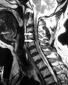 脊柱脊髓損傷